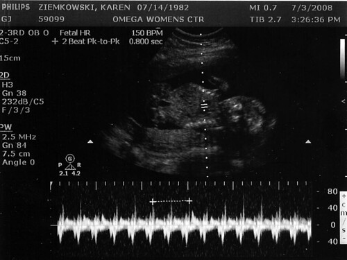 Ultrasound - Heartbeat