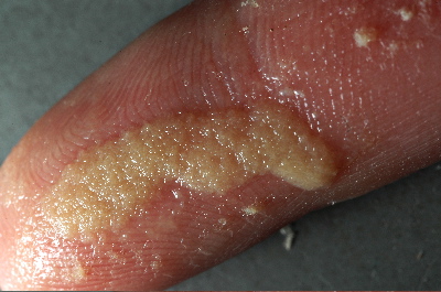 worms on fingers