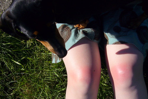 Burned Knees