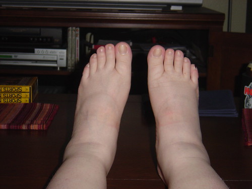 My swollen ankles and feet