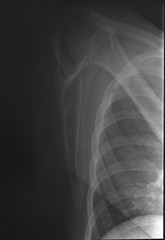 Shoulder X-Ray 3