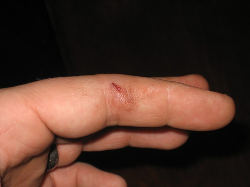 Here is the picture of Day 1 of my Rubber Mallet Injury: