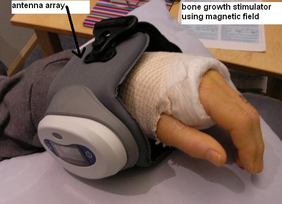 Bone Stimulator Foot