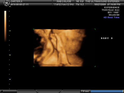 3d ultrasound pictures of twins. 3d ultrasound pictures of twins. (jcarter) Tags: 3d twins; (jcarter) Tags: 3d twins. Calidude. Apr 16, 04:38 PM
