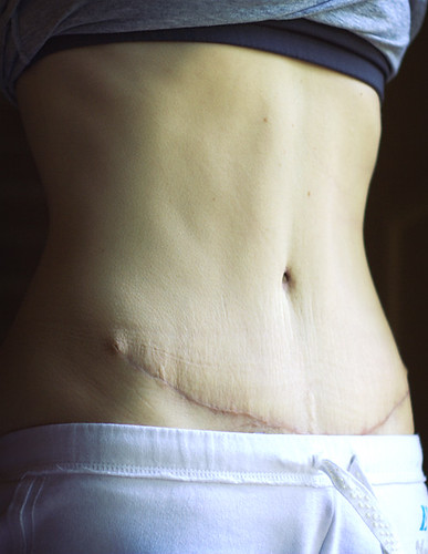 separated stomach muscles. The tummy tuck; or