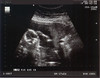 Ultrasound #2 July 23, 2008