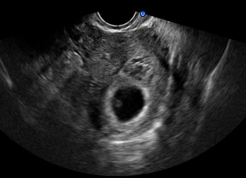 small-gestational-sac-at-6-weeks-ivf