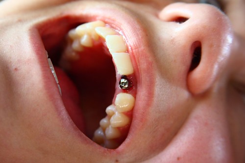 canines piercing. dental surface piercing