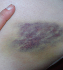 omg bruise