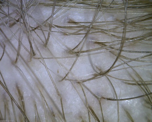 hair follicles