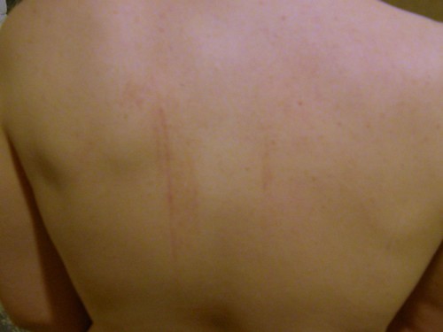 Bruises On Back. impressive ack bruises.