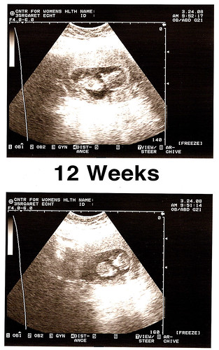 12 week ultrasound figure