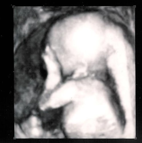 Ultrasound photo 4