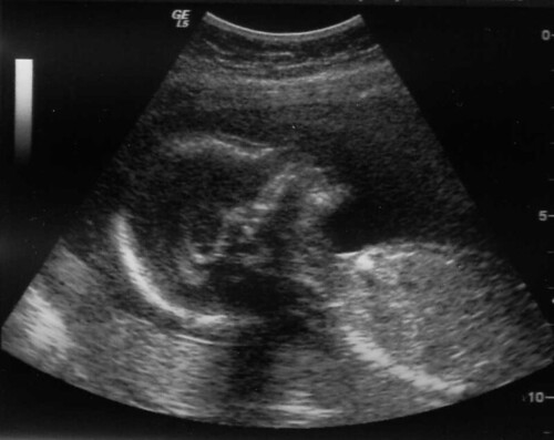 Ultrasound #2 taken @19.5 weeks