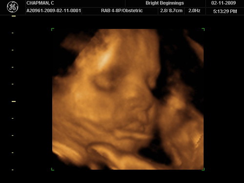 3d ultrasound pictures at 12 weeks. 3d ultrasound pictures at 12 weeks. 3d ultrasound, 32 weeks; 3d ultrasound, 32 weeks. nmrrjw66. Apr 18, 11:44 AM. I have 12mb/896k DSL through Qwest