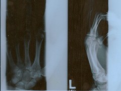 An Xray of my left middle finger after I quilted it..
