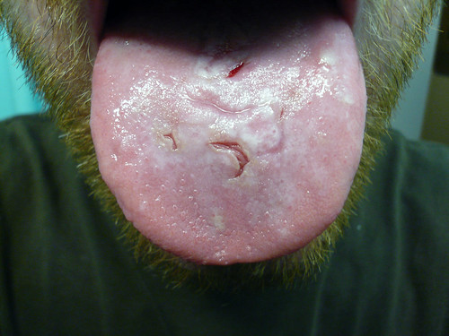Atlas Tongue