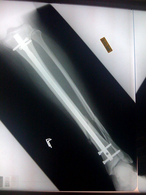  additional small tibial fracture; hairline ankle fracture 