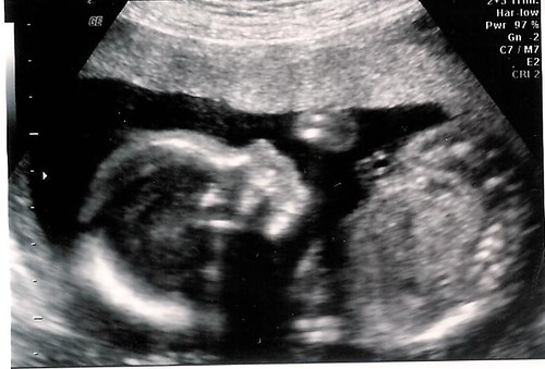Ultrasound photo 5