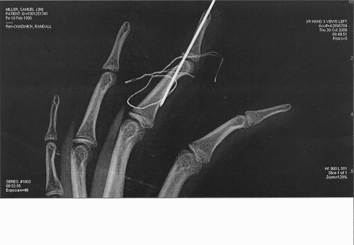 antawn jamison broken finger. Broken+finger+surgery
