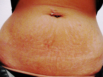 stretch marks. Anyone who is familiar with those pesky red or white lines 