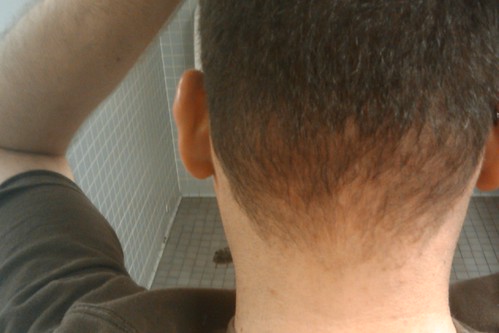 17 days: neck is mostly clear, still some redness/scabs on scalp