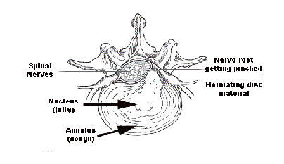herniated disc schematic with text