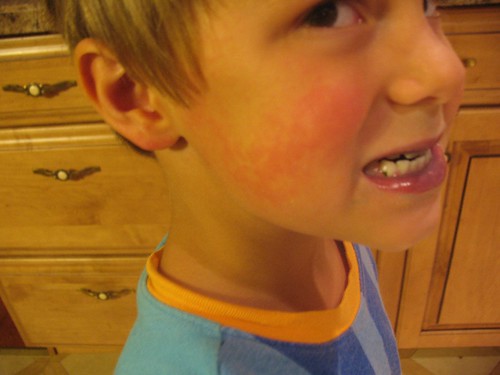 heat rash pictures in children. heat rash pictures in