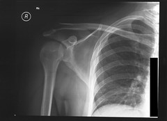 Shoulder X-Ray 1