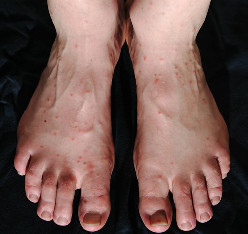 What causes red spots on the tops of feet? | Reference.com