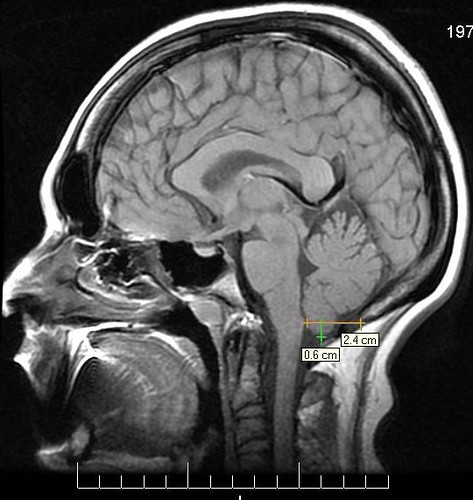 DSCN5137 · My Brain · Chiari 1 Malformation 