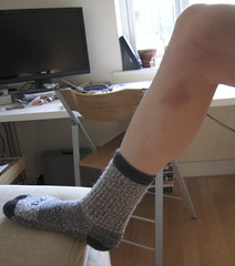 Bruise and Warm Socks