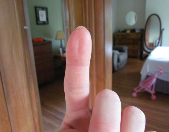 Healed Finger Felon Scar