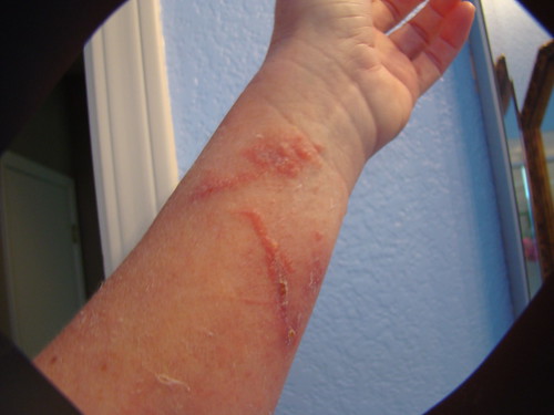 poison ivy and poison oak pictures. Poison Oak Poison Ivy Healing?