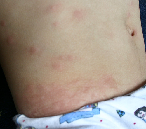 bed bugs rash. Brooke rash bug bite-March 30,