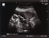 Ultrasound #3 July 23, 2008