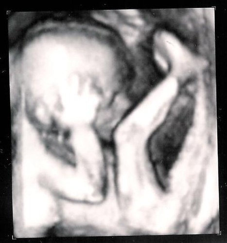Ultrasound photo 2