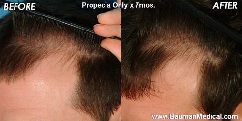 Temple Hairline Effect of Propecia x 7 mos._pt1