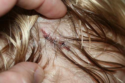 Stitches!