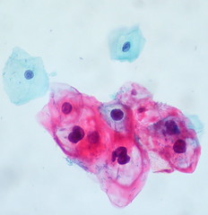 HPV infected cells