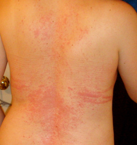 allergic reaction rash. We DO know it#39;s an allergic