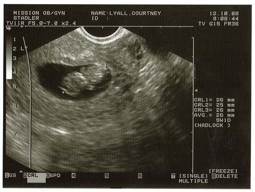 ultrasounds at 8 weeks. Baby#39;s First Ultrasound
