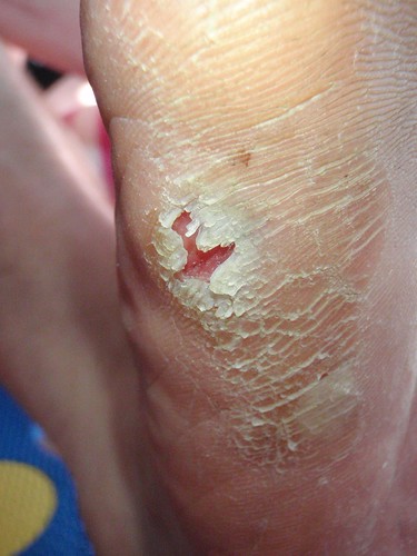 My foot after walking on a heat bead (danish:grill kul)