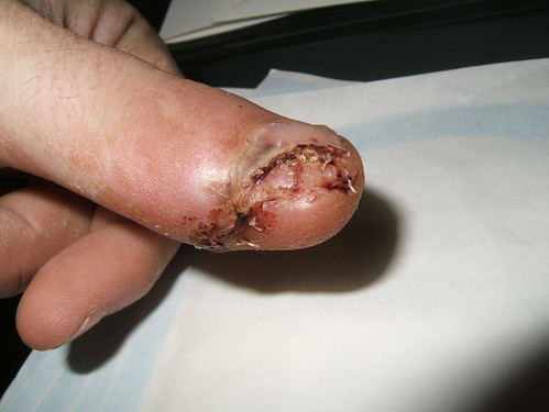After an operation to repair the nail bed and remove part of the thumb nail