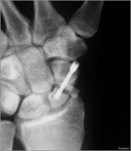 X Ray Hand. X-Ray of a Hand with a Screw