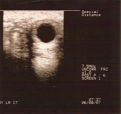 Inara Ultrasound Scan