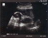 Ultrasound #4 July 23, 2008