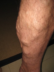 left calf and varicose veins