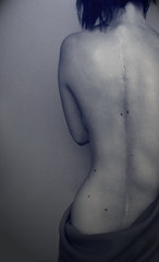 black and white photo of a woman facing away from the camera, wearing only a towel or blanket.  Her spine is curved, and her scars are visible.