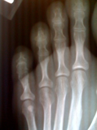 broken toe